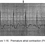 Figure 1-16. Premature atrial contraction (PAC).