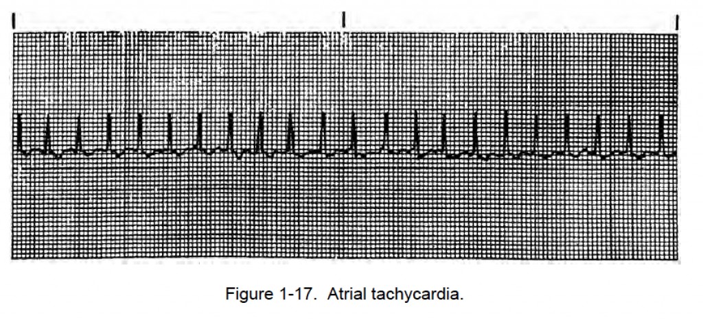 108. ATRIAL RHYTHMS Cardiac Rhythm Interpretation
