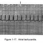 Figure 1-17. Atrial tachycardia.