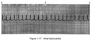 Figure 1-17. Atrial tachycardia.