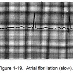 Figure 1-19. Atrial fibrillation (slow).