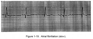 Figure 1-19. Atrial fibrillation (slow).