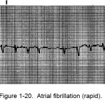 Figure 1-20. Atrial fibrillation (rapid).
