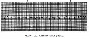 Figure 1-20. Atrial fibrillation (rapid).