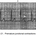 Figure 1-21. Premature junctional contractions (PJC).