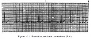 Figure 1-21. Premature junctional contractions (PJC).