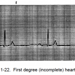 Figure 1-22. First degree (incomplete) heart block