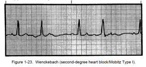 Figure 1-23. Wenckebach (second-degree heart block/Mobitz Type I).