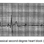 Figure 1-24. Classical second-degree heart block (Mobitz Type II).