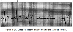 Figure 1-24. Classical second-degree heart block (Mobitz Type II).