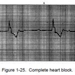 Figure 1-25. Complete heart block