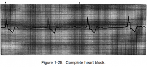 Figure 1-25. Complete heart block