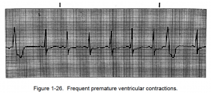 Figure 1-26. Frequent premature ventricular contractions.