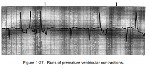 Figure 1-27. Runs of premature ventricular contractions.