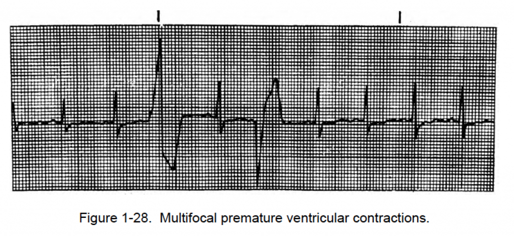 Figure 1 28 Multifocal Premature Ventricular Contractions Cardiac