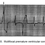Figure 1-28. Multifocal premature ventricular contractions.