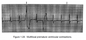 Figure 1-28. Multifocal premature ventricular contractions.