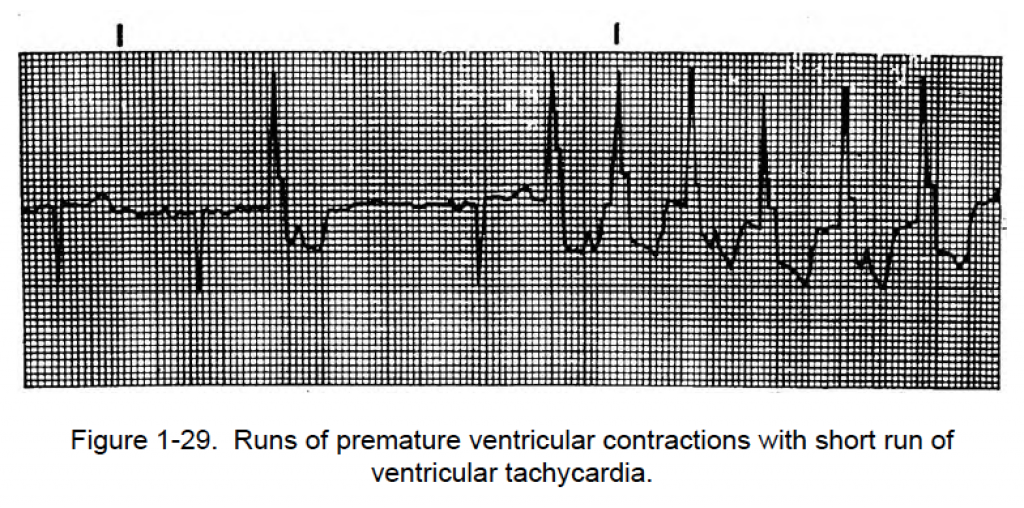 Figure 1-29. Runs of PVCS with short run of V Tachycardia. | Cardiac ...