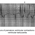Figure 1-29. Runs of PVCS with short run of V Tachycardia.