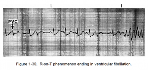 Figure 1-30. R-on-T phenomenon ending in ventricular fibrillation.