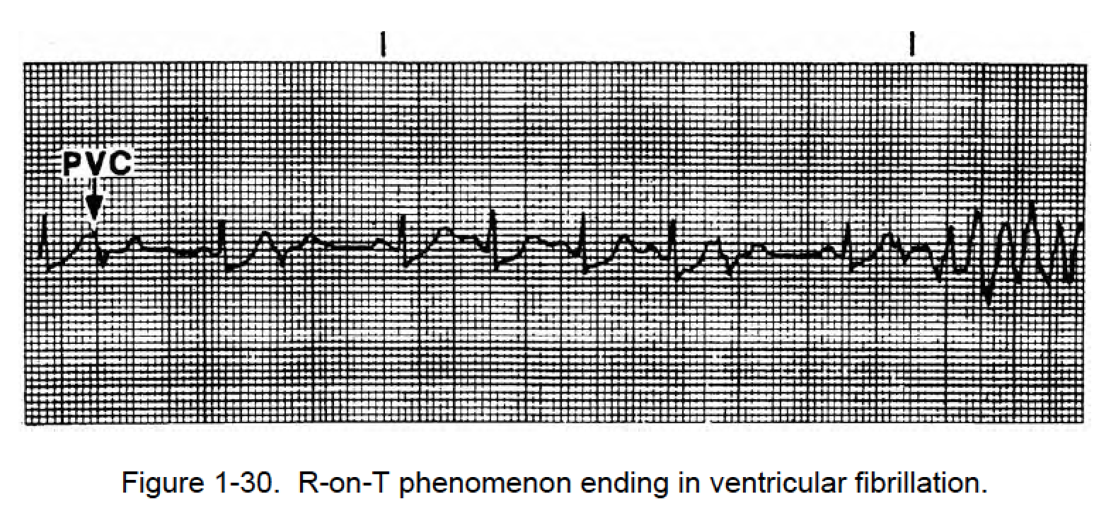 1 11 Ventricular Arrhythmias B Pvc S Cardiac Rhythm