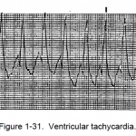 Figure 1-31. Ventricular tachycardia.