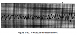 Figure 1-32. Ventricular fibrillation (fine).