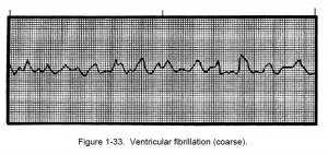 Figure 1-33. Ventricular fibrillation (coarse).