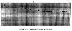 Figure 1-35. Asystole (cardiac standstill).
