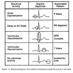 Figure 1-5. Electrocardiogram wave patterns produced by electrical activity in the heart.