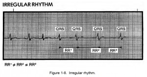 Figure 1-8. Irregular rhythm