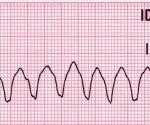 Lead_II_rhythm_ventricular_tachycardia_Vtach_VT. By Glenlarson (Own work) [Public domain], via Wikimedia Commons