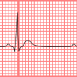 Premature Atrial Contraction. By Chikumaya (My Own Work) [Public domain], via Wikimedia Commons