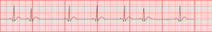 Premature Atrial Contraction. By Chikumaya (My Own Work) [Public domain], via Wikimedia Commons