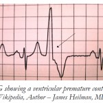 ECG showing a ventricular premature contraction.[ Source – Wikipedia, Author – James Heilman, MD].