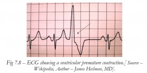 ECG showing a ventricular premature contraction.[ Source – Wikipedia, Author – James Heilman, MD].