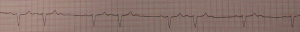 Second-Degree Heart Block:Mobitz Type I. By James Heilman, MD (Own work) [CC BY-SA 3.0 (http://creativecommons.org/licenses/by-sa/3.0)], via Wikimedia Commons