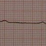 Second degree heart block type 2. By James Heilman, MD (Own work) [CC BY-SA 3.0 (http://creativecommons.org/licenses/by-sa/3.0)], via Wikimedia Commons