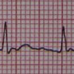 Atrial Fibrillation. By James Heilman, MD (Own work) [CC BY-SA 3.0 (http://creativecommons.org/licenses/by-sa/3.0)], via Wikimedia Commons