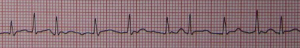 Atrial Fibrillation. By James Heilman, MD (Own work) [CC BY-SA 3.0 (http://creativecommons.org/licenses/by-sa/3.0)], via Wikimedia Commons