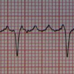 Atrial Flutter. By James Heilman, MD (Own work) [CC BY-SA 3.0 (http://creativecommons.org/licenses/by-sa/3.0) or GFDL (http://www.gnu.org/copyleft/fdl.html)], via Wikimedia Commons