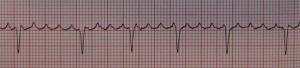 Atrial Flutter. By James Heilman, MD (Own work) [CC BY-SA 3.0 (http://creativecommons.org/licenses/by-sa/3.0) or GFDL (http://www.gnu.org/copyleft/fdl.html)], via Wikimedia Commons
