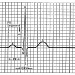 Electrocardiograph waves, segments, and intervals