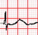 First Degree Heart Block. By Michael Rosengarten BEng, MD.McGill [CC BY-SA 3.0 (http://creativecommons.org/licenses/by-sa/3.0)], via Wikimedia Commons