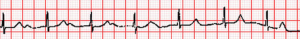 First Degree Heart Block. By Michael Rosengarten BEng, MD.McGill [CC BY-SA 3.0 (http://creativecommons.org/licenses/by-sa/3.0)], via Wikimedia Commons