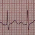 Sinus Tachycardia. By James Heilman, MD (Own work) [CC BY-SA 3.0 (http://creativecommons.org/licenses/by-sa/3.0)], via Wikimedia Commons