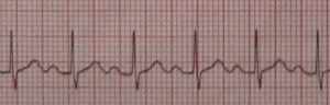 Sinus Tachycardia. By James Heilman, MD (Own work) [CC BY-SA 3.0 (http://creativecommons.org/licenses/by-sa/3.0)], via Wikimedia Commons