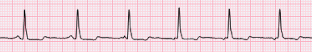 1-08. ATRIAL RHYTHMS - Cardiac Rhythm Interpretation