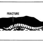 Figure 2-9. Padding placed under the casualty's neck and back.
