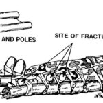 Figure 4-7. Improvised blanket and poles splint applied to a fractured leg.